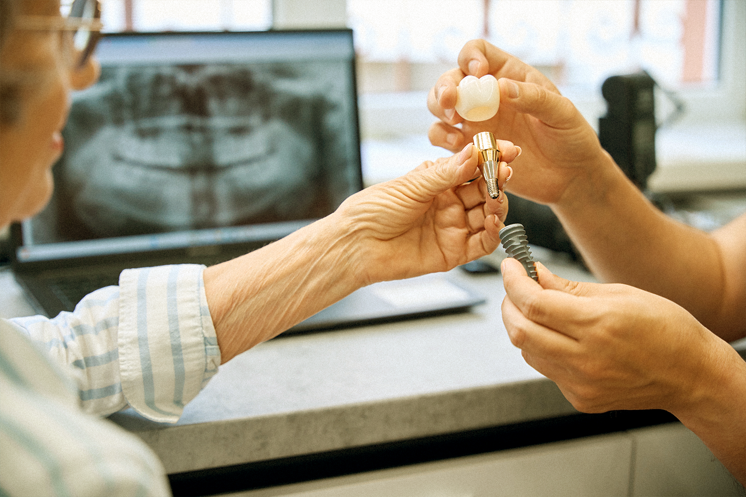Implantes Dentários